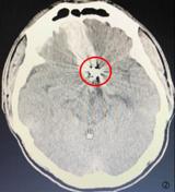 颅内动脉瘤术后还会不会复发？