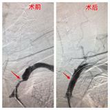 我院完成首例锁骨下动脉支架植入手术