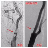 我院成功开展首例颈动脉狭窄支架植入手术