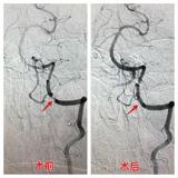 我院成功进行颅内段双侧椎动脉狭窄支架植入手术