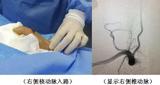 我院成功开展首例经桡动脉入路全脑血管造影手术