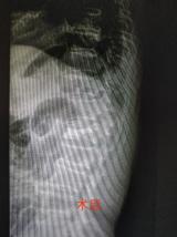 经皮椎体成形术让抗美援朝老兵恢复活力