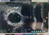 我院成功开展首例血管内超声（IVUS）指导下冠脉介入治疗