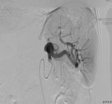 我院介入科成功完成首例脾动脉瘤栓塞术
