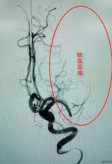 【突破】我院完成首例脑栓塞机械取栓手术