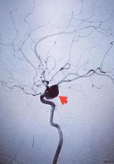 【技术推介】我院成功将一患者颅内巨大“定时炸弹”拆除——双微导管技术栓塞颅内巨大动脉瘤侧记