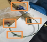 “管”理有道，超声介入为引流管堵塞患者解难题