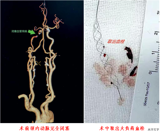 突破80+手术禁区！我院神经介入团队完成高龄取栓“极限挑战”