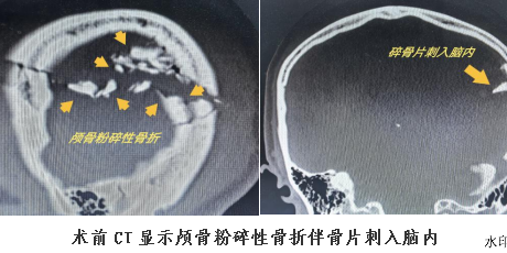 无人机翼“惹大祸”击穿颅骨   医生妙手“补脑洞”化险为夷