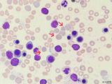 血涂片里的“隐形凶手”——检验科精准识别，揪出罕见铅中毒真相
